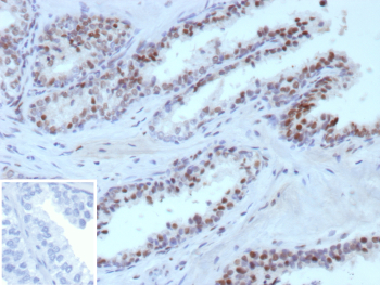Immunohistochemistry analysis of ERG in human prostate carcinoma tissue. Formalin-fixed, paraffin-embedded human prostate carcinoma tissue was stained using ERG/ETS related gene antibody (clone ERG1/12589), showing distinct nuclear staining in tumor epithelial cells consistent with ERG expression in prostate carcinoma. Heat-induced epitope retrieval was performed by heating tissue sections in 10 mM Tris with 1 mM EDTA, pH 9.0, at 95oC for 45 minutes, followed by cooling at room temperature for 20 minutes. Inset shows PBS substituted for the primary antibody as a secondary-only negative control.