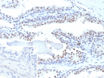 Immunohistochemistry analysis of ERG in human prostate carcinoma tissue. Formalin-fixed, paraffin-embedded human prostate carcinoma tissue was stained using ERG/Prostate cancer ERG antibody (clone ERG1/12589), showing distinct nuclear staining in tumor epithelial cells consistent with prostate cancer-associated ERG expression. Heat-induced epitope retrieval was performed by heating tissue sections in 10 mM Tris with 1 mM EDTA, pH 9.0, at 95oC for 45 minutes, followed by cooling at room temperature for 20 minutes. Inset shows PBS substituted for the primary antibody as a secondary-only negative control.