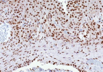 Immunohistochemistry analysis of Estrogen receptor beta in human ovarian carcinoma tissue. Formalin-fixed, paraffin-embedded human ovarian carcinoma tissue was stained using Estrogen receptor beta/ER beta antibody (clone ESR2/9709), showing nuclear immunoreactivity in tumor cells consistent with Estrogen receptor beta expression encoded by the ESR2 gene. Heat-induced epitope retrieval was performed by heating tissue sections in 10 mM Tris with 1 mM EDTA, pH 9.0, at 95oC for 45 minutes, followed by cooling at room temperature for 20 minutes prior to immunostaining.