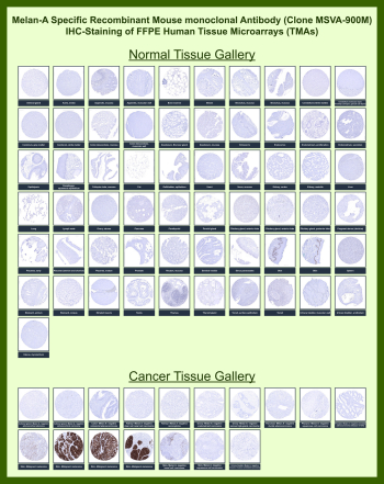 Immunohistochemistry analysis of Melanoma antigen recognized by T-cells 1 in FFPE human tissue microarrays. Formalin-fixed, paraffin-embedded human normal and cancer tissue microarrays were stained with recombinant MART-1/Melanoma antigen recognized by T-cells 1 antibody (clone MSVA-900M). Brown chromogenic signal indicates MART-1-positive cells, with strong cytoplasmic staining observed in malignant melanoma tissues and absence of staining in most non-melanocytic normal and cancer tissues, consistent with the expected melanocytic lineage-specific expression pattern.