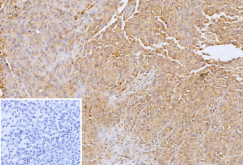 Formalin-fixed, paraffin-embedded human melanoma stained with GPC3/Glypican-3 antibody (clone GPC3/12698). Tumor cells show diffuse cytoplasmic and membranous brown chromogenic staining, consistent with Glypican-3 expression in melanoma cells, while nuclei are counterstained blue. Inset shows a PBS-only negative control processed without primary antibody, demonstrating minimal non-specific background staining.
