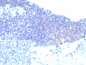 Immunohistochemistry analysis of CD25 / IL2RA antibody (clone IL2RA/9378R) in human tonsil. Formalin-fixed, paraffin-embedded human tonsil tissue shows membranous and cytoplasmic brown chromogenic staining in scattered lymphoid cells, consistent with IL2RA-positive immune cell populations. Inset shows a PBS-only negative control processed without primary antibody, demonstrating minimal non-specific background staining.