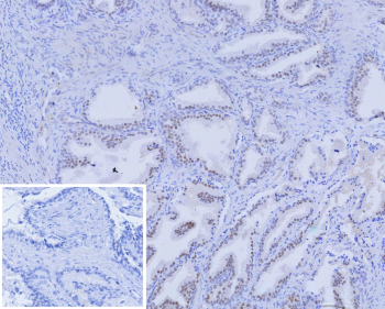 Immunohistochemistry analysis of recombinant AR / Androgen receptor antibody (clone r2F12) in human prostate. Formalin-fixed, paraffin-embedded human prostate tissue shows nuclear brown chromogenic staining in glandular epithelial cells, consistent with androgen receptor-positive prostate epithelium and expected nuclear localization of this steroid hormone receptor. The inset shows a PBS-only negative control processed without primary antibody, demonstrating minimal non-specific background staining.