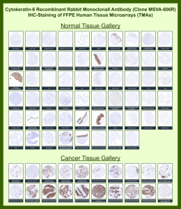 Immunohistochemistry analysis of KRT6A / Keratin 6A antibody (clone MSVA-606R) in human tissue microarrays. Formalin-fixed, paraffin-embedded human normal and cancer tissue microarrays show cytoplasmic brown chromogenic staining in stratified squamous epithelia and selected epithelial-derived tumors, consistent with known Keratin 6A expression patterns. Broad low-level or absent staining is observed across most non-squamous normal tissues, while stronger staining is evident in squamous epithelium and multiple squamous cell carcinomas. The observed staining distribution is consistent with publicly available Human Protein Atlas expression data.