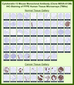 Immunohistochemistry analysis of Suprabasal squamous keratin / Cytokeratin 13 antibody (clone MSVA-613M) in human tissues. Formalin-fixed, paraffin-embedded (FFPE) human tissue microarrays containing a broad panel of normal and cancer tissues were stained with Cytokeratin 13 mouse monoclonal antibody (clone MSVA-613M). In normal tissues, brown chromogenic signal is observed predominantly in suprabasal squamous epithelial cells, including esophageal squamous epithelium, tonsillar surface epithelium, ectocervix, and urothelium, while most non-squamous tissues show little to no staining. In cancer tissues, strong cytoplasmic brown staining is observed in squamous cell carcinomas, whereas non-squamous malignancies such as adenocarcinomas and mesothelioma are largely negative. Staining patterns are consistent with known Cytokeratin 13 / KRT13 expression profiles reported in publicly available expression datasets.