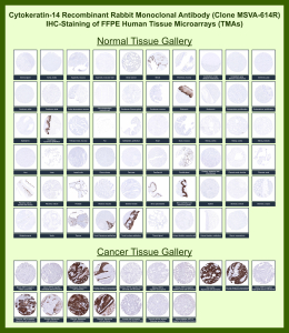 Immunohistochemistry analysis of Basal cell keratin / Cytokeratin 14 antibody (clone MSVA-614R) in human tissues. Formalin-fixed, paraffin-embedded human tissue microarrays containing a wide range of normal and cancer tissues were stained using Basal cell keratin / Cytokeratin 14 recombinant rabbit monoclonal antibody (clone MSVA-614R). In normal tissues, brown chromogenic signal is observed in basal epithelial cells, including prostate basal cells and basal keratinocytes of stratified squamous epithelia such as skin, tonsillar surface epithelium, esophageal squamous epithelium, ectocervical epithelium, and urothelium, while most non-squamous tissues show little to no staining. In cancer tissues, strong cytoplasmic brown staining is observed in squamous cell carcinomas, whereas non-squamous malignancies such as adenocarcinomas and renal cell carcinomas are largely negative. The observed staining distribution is consistent with the known basal cell-restricted expression pattern of Cytokeratin 14 in human tissues.