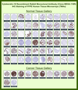Immunohistochemistry analysis of Keratin 18 / Cytokeratin 18 antibody (clone MSVA-118R) in human tissues. Formalin-fixed, paraffin-embedded human tissue microarrays containing a broad range of normal and cancer tissues were stained using Keratin 18 / Cytokeratin 18 recombinant rabbit monoclonal antibody (clone MSVA-118R). In normal tissues, brown chromogenic signal is observed predominantly in epithelial cell populations of simple and glandular epithelia, including gastrointestinal mucosa, pancreatic acini and ducts, renal tubular epithelium, hepatocytes, bronchial epithelium, endometrial glands, and prostatic glandular epithelium, while mesenchymal and stromal tissues show little to no staining. In cancer tissues, strong cytoplasmic brown staining is observed in carcinomas with glandular or epithelial differentiation, whereas non-epithelial malignancies show reduced or absent staining. The observed staining distribution reflects epithelial-associated expression of Keratin 18 in human tissues.