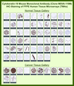 Immunohistochemistry analysis of Simple epithelial keratin / Cytokeratin 19 antibody (clone MSVA-119M) in human tissues. Formalin-fixed, paraffin-embedded human tissue microarrays containing a broad range of normal and cancer tissues were stained using Simple epithelial keratin / Cytokeratin 19 mouse monoclonal antibody (clone MSVA-119M). In normal tissues, brown chromogenic signal is observed predominantly in simple and glandular epithelial cells, including gastrointestinal mucosa, pancreatic ducts, bile ducts, renal tubular epithelium, bronchial epithelium, endometrial glands, prostatic glandular epithelium, and urothelium, while stratified squamous epithelia show limited staining and mesenchymal tissues show little to no signal. In cancer tissues, strong cytoplasmic brown staining is observed in carcinomas with glandular or ductal differentiation, whereas non-epithelial malignancies are largely negative. The observed staining distribution reflects epithelial-associated expression of Cytokeratin 19 in human tissues.