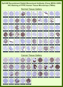 Immunohistochemistry analysis of recombinant CD326 / Epithelial cell adhesion molecule antibody (clone MSVA-326R) in human normal and cancer tissues. Formalin-fixed, paraffin-embedded human tissue microarrays were stained using recombinant CD326/Epithelial cell adhesion molecule antibody (clone MSVA-326R). Strong membranous staining is observed in a wide range of normal epithelial tissues including colon mucosa, small intestine, stomach, prostate, endometrium, and other glandular epithelia, while non-epithelial tissues such as skeletal muscle and lymphoid structures show minimal to absent staining. In cancer tissues, prominent membranous positivity is seen in multiple carcinomas including colorectal adenocarcinoma, breast carcinoma, lung adenocarcinoma, ovarian carcinoma, pancreatic carcinoma, and urothelial carcinoma. Mesenchymal tumors and non-epithelial malignancies show little to no staining. The staining pattern aligns with Human Protein Atlas expression data and reflects epithelial lineage-restricted expression of CD326/EpCAM. 