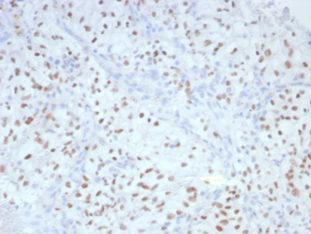 Formalin-fixed, paraffin-embedded human renal cell carcinoma stained with PAX2 Recombinant Mouse Monoclonal Antibody (rPAX2/8506). HIER: Tris/EDTA, pH9.0, 45min. 2¬?: HRP-polymer, 30min. DAB, 5min.