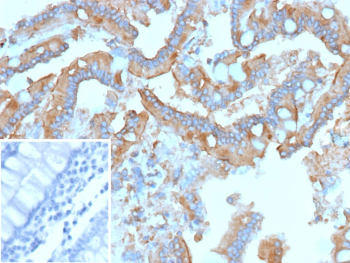 Immunohistochemistry analysis of RET Proto-Oncogene/Colorectal Cancer Marker antibody (clone r3F8) in human colon carcinoma tissue. FFPE human colon carcinoma shows membranous and cytoplasmic HRP-DAB brown staining in malignant epithelial cells lining glandular structures, consistent with RET expression. Staining highlights tumor cell membranes with additional cytoplasmic signal, while surrounding stromal elements demonstrate comparatively weaker reactivity. Nuclei are counterstained blue. The inset image represents a secondary antibody negative control in which PBS was used in place of the primary antibody and shows absence of specific staining. Heat induced epitope retrieval was performed by heating tissue sections in 10 mM Tris with 1 mM EDTA, pH 9.0, at 95oC for 45 minutes followed by cooling at room temperature for 20 minutes prior to immunostaining.