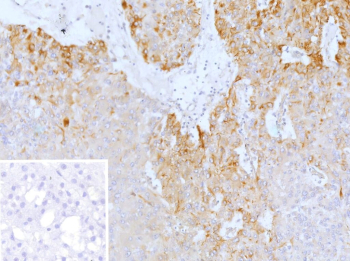 Immunohistochemistry analysis of PRPH/Peripherin antibody in human adrenal gland tissue. FFPE human adrenal sections show HRP-DAB brown cytoplasmic staining in neuronal elements and nerve fibers within the adrenal medulla, consistent with Peripherin expression in peripheral neuroendocrine-associated cells. Cortical cells demonstrate minimal to no staining. The inset negative control, in which PBS was used in place of primary antibody, shows no specific brown chromogenic signal. Heat induced epitope retrieval was performed in 10 mM Tris with 1 mM EDTA, pH 9.0, by heating at 95oC for 45 minutes followed by cooling at room temperature for 20 minutes.