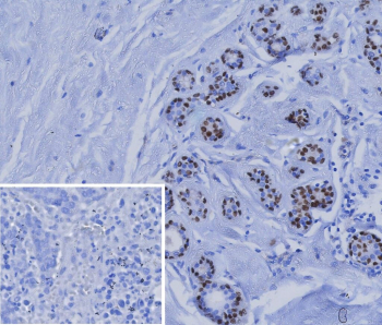 Immunohistochemistry analysis of Transcription factor SOX10 antibody (clone rSOX10/991) in formalin-fixed, paraffin-embedded human breast carcinoma tissue. Distinct nuclear staining is observed in tumor cells, consistent with SOX10 expression. The inset shows PBS used in place of primary antibody as a negative control, demonstrating absence of specific staining. Antigen retrieval was performed by heating tissue sections in 10 mM Tris with 1 mM EDTA, pH 9.0, for 45 minutes at 95oC followed by cooling at room temperature for 20 minutes.