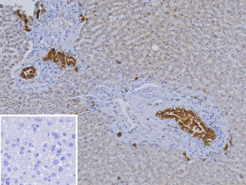 Immunohistochemistry analysis of Hepatocyte nuclear factor 1 beta/HNF1B antibody in human liver carcinoma tissue (clone HNF1B/9519). FFPE human liver carcinoma sections demonstrate HRP-DAB brown nuclear staining in clusters of tumor epithelial cells, consistent with nuclear localization of Hepatocyte nuclear factor 1 beta. Surrounding non-neoplastic hepatocytes show comparatively weaker or absent staining. The inset shows PBS used in place of primary antibody as a secondary antibody negative control, demonstrating absence of specific brown staining. Heat induced epitope retrieval was performed in 10 mM Tris with 1 mM EDTA, pH 9.0, by heating tissue sections at 95oC for 45 minutes followed by cooling at room temperature for 20 minutes prior to antibody incubation.