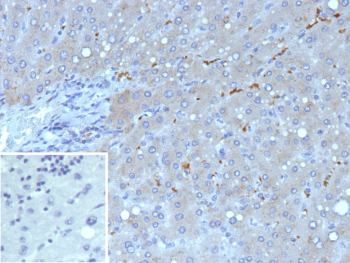 Immunohistochemistry analysis of TCF2 / HNF1B antibody in human liver carcinoma tissue (clone HNF1B/9519). FFPE human liver carcinoma sections show HRP-DAB brown nuclear staining in scattered tumor epithelial cells, consistent with nuclear localization of Hepatocyte nuclear factor 1 beta. Surrounding stromal areas demonstrate minimal to absent staining. The inset shows PBS used in place of primary antibody as a secondary antibody negative control, confirming absence of specific brown signal. Heat induced epitope retrieval was performed in 10 mM Tris with 1 mM EDTA, pH 9.0, by heating tissue sections at 95oC for 45 minutes followed by cooling at room temperature for 20 minutes prior to antibody incubation.