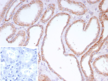 Immunohistochemistry analysis of CD202b / TIE2 antibody in human renal cell carcinoma tissue (clone TEK/9411). FFPE human renal cell carcinoma sections show HRP-DAB brown membranous and cytoplasmic staining outlining vascular endothelial cells within tumor-associated microvessels, consistent with TEK receptor tyrosine kinase localization. Tumor epithelial cells demonstrate minimal to weak staining compared to endothelial structures. The inset shows PBS used in place of primary antibody as a secondary antibody negative control, confirming absence of specific brown signal. Heat induced epitope retrieval was performed in 10 mM Tris with 1 mM EDTA, pH 9.0, by heating tissue sections at 95oC for 45 minutes followed by cooling at room temperature for 20 minutes prior to antibody incubation.