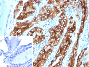 Immunohistochemistry analysis of Thyroid Globulin / TG antibody in human thyroid tissue (clone TGB/4582R). FFPE human thyroid sections demonstrate strong HRP-DAB brown cytoplasmic staining in follicular epithelial cells, with intense brown chromogenic signal filling the follicular lumina corresponding to colloid material. The staining pattern is consistent with abundant Thyroglobulin synthesis and secretion by differentiated thyroid follicular cells. Surrounding stromal elements show minimal staining. The inset shows PBS used in place of primary antibody as a secondary antibody negative control, confirming absence of specific brown chromogenic signal. Heat induced epitope retrieval was performed in 10 mM Tris with 1 mM EDTA, pH 9.0, by heating tissue sections at 95oC for 45 minutes followed by cooling at room temperature for 20 minutes prior to antibody incubation.