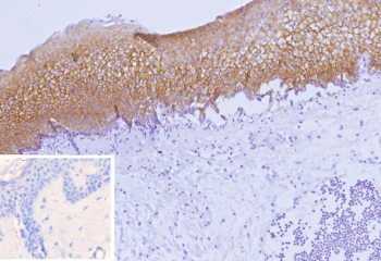 Immunohistochemistry analysis of Nectin cell adhesion molecule 4 / NECTIN4 antibody (clone NECTIN4/9906) in human skin tissue. Formalin-fixed, paraffin-embedded skin demonstrates strong membranous HRP-DAB brown staining within the epidermal keratinocyte layer, outlining cell-cell borders consistent with surface localization of Nectin-4. The underlying dermis shows minimal staining, supporting epithelial-restricted expression. Hematoxylin counterstain highlights tissue morphology and nuclei. The inset shows PBS used in place of primary antibody as a negative control, confirming absence of non-specific secondary antibody binding. Heat-induced epitope retrieval was performed by heating tissue sections in 10 mM Tris with 1 mM EDTA, pH 9.0, for 45 minutes at 95oC followed by cooling at room temperature for 20 minutes prior to staining.