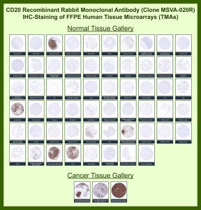 Immunohistochemistry analysis of MS4A1 Antibody for IHC in human tissue microarrays. Recombinant rabbit monoclonal antibody (clone MSVA-020R) demonstrates strong membranous HRP-DAB brown staining in B-cell rich tissues including tonsil, lymph node, and spleen, consistent with CD20/MS4A1 surface expression, while most non-lymphoid tissues show minimal or absent staining. In cancer tissues, diffuse membranous staining is observed in B-cell lymphomas, supporting lineage-specific expression. The observed staining distribution across normal and malignant samples aligns with published MS4A1 expression patterns reported in the Human Protein Atlas.