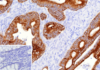 Formalin-fixed, paraffin-embedded human colon carcinoma stained with MUC16 Mouse Monoclonal Antibody (CA125/8893). Inset: PBS instead of primary antibody; secondary only negative control.