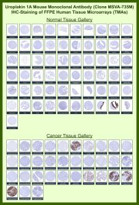 Immunohistochemistry of UPK1A Antibody for IHC in human tissue microarrays. Mouse monoclonal clone MSVA-735M shows strong membranous staining in normal urothelium of the urinary bladder, with minimal to absent staining in most non-urothelial tissues. In cancer tissue microarrays, selective membranous positivity is observed in urothelial carcinoma, while the majority of non-urothelial malignancies remain negative. Staining patterns are consistent with reported Uroplakin 1A expression profiles in the Human Protein Atlas.