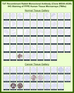 DNA nucleotidylexotransferase Rabbit Recombinant Monoclonal Antibody (MSVA-453R) tested on many normal and cancer tissues. The immunohistochemistry staining in these tissues aligns with the expression data in Human Protein Atlas. <br><br>Manual Protocol: Freshly cut sections should be used (less than 10 days between cutting and staining). Heat-induced antigen retrieval for 5 minutes in an autoclave at 121oC in pH 7.8 Target Retrieval Solution buffer. Apply the antibody at a dilution of 1:150 at 37oC for 60 minutes. Visualization of bound antibody by the EnVision Kit (Dako, Agilent) according to the manufacturer's directions.