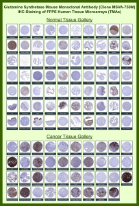 Immunohistochemistry analysis of formalin-fixed, paraffin-embedded human tissue microarrays stained with GS/Glutamine Synthetase antibody (clone MSVA-750M). Representative normal and cancer tissues show variable cytoplasmic brown chromogenic staining patterns across organ types, consistent with known tissue- and tumor-dependent expression of Glutamine synthetase, while nuclei are counterstained blue. The overall distribution and relative staining intensities observed across tissues are consistent with publicly available expression datasets for Glutamine synthetase.