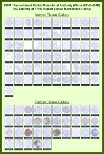 INSM1 Antibody for IHC (clone MSVA-456R). Immunohistochemistry analysis of Insulinoma-associated protein 1 (INSM1) in formalin-fixed, paraffin-embedded human tissue microarrays using a recombinant rabbit monoclonal antibody. The INSM1 Antibody for IHC (clone MSVA-456R) demonstrates strong nuclear staining in neuroendocrine tumor cells including small cell lung carcinoma, neuroendocrine tumors, and Merkel cell carcinoma, while most non-neuroendocrine tissues remain negative. The nuclear HRP-DAB staining pattern highlights the transcription factor localization of INSM1 within tumor cell nuclei, consistent with its role as a neuroendocrine lineage marker. Staining distribution across normal and cancer tissues corresponds with reported INSM1 expression profiles in Human Protein Atlas datasets.