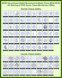 MCM7 Antibody for IHC - immunohistochemistry staining across human normal and cancer tissues. Tissue microarrays of FFPE human normal and tumor tissues were stained with MCM7 Antibody for IHC (clone MSVA-507R), a recombinant rabbit monoclonal antibody targeting Minichromosome maintenance protein 7 / MCM7. Nuclear HRP-DAB brown chromogenic staining highlights proliferating cell populations in several tissues, including strong staining of germinal center lymphocytes in lymph node and tonsil, intestinal epithelial cells within colon and appendix mucosa, proliferative compartments of the endometrium, and subsets of epithelial cells in tissues such as testis and bronchial mucosa. Many differentiated tissues including skeletal muscle, heart muscle, and mature stromal compartments show little or no staining, consistent with the lower proliferative activity of these cells. Across the cancer tissue panel, strong nuclear staining is observed in multiple tumor types including colorectal carcinoma, breast carcinoma, lung carcinoma, and lymphoid malignancies, reflecting the elevated DNA replication activity of proliferating tumor cells. The observed staining patterns across the normal and cancer tissue panels align with published expression profiles reported in the Human Protein Atlas.