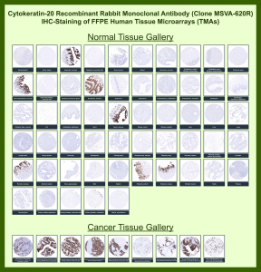 KRT20 Antibody for IHC (clone MSVA-620R). Immunohistochemistry analysis of multiple human normal and cancer tissues using recombinant rabbit monoclonal KRT20 antibody (clone MSVA-620R) on tissue microarrays. HRP-DAB brown chromogenic staining highlights cytoplasmic Keratin 20 / Cytokeratin 20 (KRT20) expression primarily in gastrointestinal epithelial cells, including strong staining of colonic and rectal mucosa, while most non-epithelial tissues remain negative. In cancer tissues, positive staining is observed in epithelial-derived tumors consistent with the known expression pattern of this intermediate filament protein. The immunohistochemistry staining patterns observed across these tissues align with reported expression profiles for KRT20 in the Human Protein Atlas.