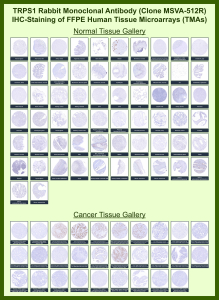 Zinc finger transcription factor Trps1 Rabbit Recombinant Monoclonal Antibody (MSVA-512R) tested on many normal and cancer tissues. The immunohistochemistry staining in these tissues aligns with the expression data in Human Protein Atlas. <br><br>Manual Protocol: Freshly cut sections should be used (less than 10 days between cutting and staining). Heat-induced antigen retrieval for 5 minutes in an autoclave at 121oC in pH 7.8 Target Retrieval Solution buffer. Apply the antibody at a dilution of 1:150 at 37oC for 60 minutes. Visualization of bound antibody by the EnVision Kit (Dako, Agilent) according to the manufacturer's directions.