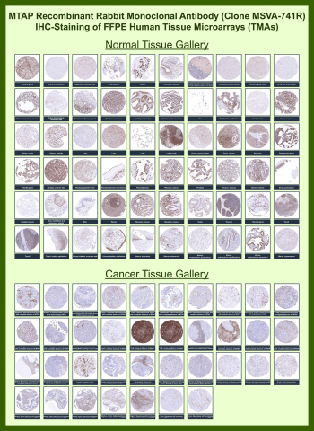 MTAP Antibody for IHC Tissue Microarray (TMA). Immunohistochemistry analysis of Methylthioadenosine phosphorylase (MTAP) across human tissue microarray (TMA) panels using MTAP antibody clone MSVA-741R. Formalin-fixed, paraffin-embedded human tissue microarrays containing a wide range of normal and cancer tissues show predominantly cytoplasmic staining in normal tissues, while many tumor samples demonstrate reduced or absent expression. The staining pattern highlights differential MTAP expression between normal and malignant tissues, consistent with its role in cellular metabolism and tumor-associated gene loss.
