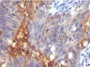 IHC testing of FFPE human colon carcinoma and Secretory Component Glycoprotein antibody (clone SRGP85). Staining of formalin-fixed tissues requires boiling tissue sections in pH 9 10mM Tris with 1mM EDTA for 10-20 min followed by cooling at RT for 20 min.