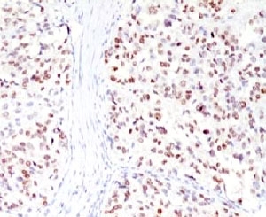 IHC testing of FFPE human melanoma with MITF antibody (clone MPAF3). Staining of formalin-fixed tissues requires boiling tissue sections in pH 9 10mM Tris with 1mM EDTA for 10-20 min. followed by cooling at RT for 20 min.