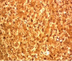 IHC testing of FFPE human hepatocellular carcinoma and Arginase 1 antibody (clone T1ARG-1).