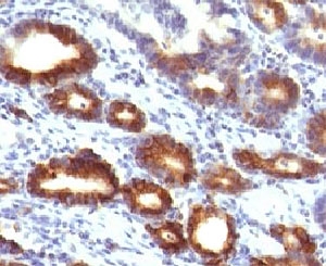 IHC testing of FFPE human gastric carcinoma with Mucin-6 antibody (clone MUCN6-1). FFPE testing requires sections to be boiled in pH 9 10mM Tris with 1mM EDTA for 10-20 minutes, followed by cooling at RT for 20 minutes, prior to staining.