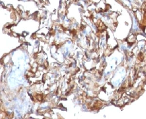 IHC testing of human melanoma and CD146 antibody