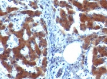 IHC testing of FFPE human hepatocellular carcinoma  with RBP (clone RLBD1). Staining of formalin-fixed tissues requires boiling tissue sections in pH 9 10mM Tris with 1mM EDTA for 10-20 min followed by cooling at RT for 20 min.