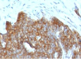 IHC testing of FFPE ovarian carcinoma with TFF1 antibody (clone BCEIP1).