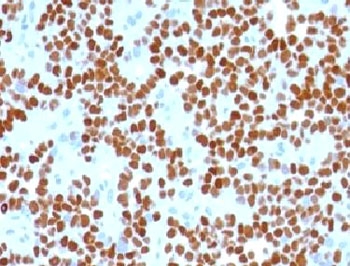 IHC testing of Ewing's sarcoma with NKX2.2 antibody (clone NK2TF-1). Staining of formalin-fixed tissues requires boiling tissue sections in pH 9 10mM Tris with 1mM EDTA for 10-20 min followed by cooling at RT for 20 minutes.