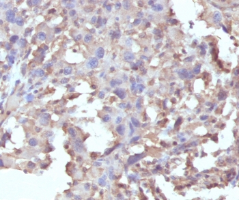IHC staining of FFPE human histiocytoma with recombinant TNF alpha antibody (clone RMTNFA-1).  Required HIER: steam sections in pH 9 10mM Tris with 1mM EDTA for 10-20 min.