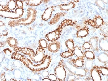 IHC testing of FFPE human renal cell carcinoma with recombinant Cadherin 16 antibody (clone CDH16/1532R). Required HIER: steam sections in 10mM Tris with 1mM EDTA, pH 9.0, for 10-20 min.