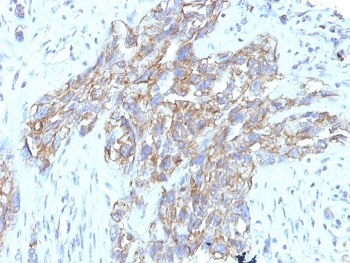 IHC staining of FFPE human lung carcinoma tissue with CD56 antibody (clone 123C3.D5 + 123A8). HIER: boil tissue sections in pH9 EDTA buffer for 10-20 min followed by cooling at RT for 20 min.