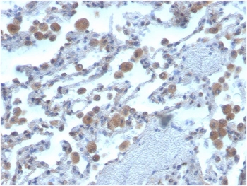 IHC staining of FFPE human lung with lung antibody. HIER: boil tissue sections in pH 9 10mM Tris with 1mM EDTA for 20 min and allow to cool before testing.