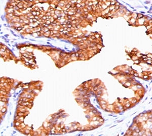 IHC staining of FFPE human prostate carcinoma with PMEPA1 antibody (clone PTAI1-1). HIER: boil tissue sections in pH 9 10mM Tris with 1mM EDTA for 10-20 min and allow to cool before testing.