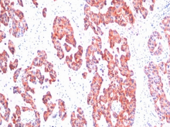IHC staining of FFPE human breast carcinoma with Basic Cytokeratin antibody (clone SPM116). HIER: boil tissue sections in pH 9 10mM Tris with 1mM EDTA for 10-20 min and allow to cool before testing.