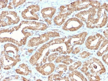 IHC staining of FFPE human prostate tissue with recombinant ODC1 antibody (clone ODC1/2878R). HIER: boil tissue sections in pH6, 10mM citrate buffer, for 10-20 min and allow to cool before testing.