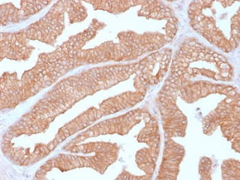 IHC testing of FFPE human prostate carcinoma with Calcineurin antibody (clone CALNA/2353). HIER: boil tissue sections in pH6, 10mM citrate buffer, for 10-20 min followed by cooling at RT for 20 min.