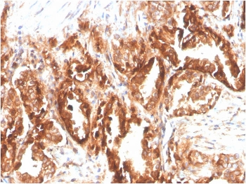 IHC staining of FFPE human prostate carcinoma with biotinylated CD47 antibody (clone CD47/2937). HIER: boil tissue sections in pH 9 10mM Tris with 1mM EDTA for 10-20 min and allow to cool before testing.