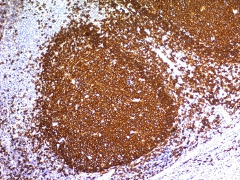 IHC staining of FFPE human tonsil tissue with CD20 antibody (clone L26). HIER: boil tissue sections in pH 9 10mM Tris with 1mM EDTA for 10-20 min and allow to cool before testing.